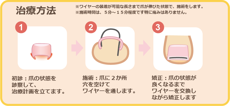 治療方法 ※ワイヤーの装着が可能な長さまで爪が伸びた状態で、施術をします。※施術時間は、5分~15分程度です 特に痛みはありません。 ①初診:爪の状態を診察して、治療計画を立てます。 ②施術:爪に2箇所穴を空けてワイヤーを通します。 ③矯正:爪の状態が良くなるまでワイヤーを交換しながら矯正します。